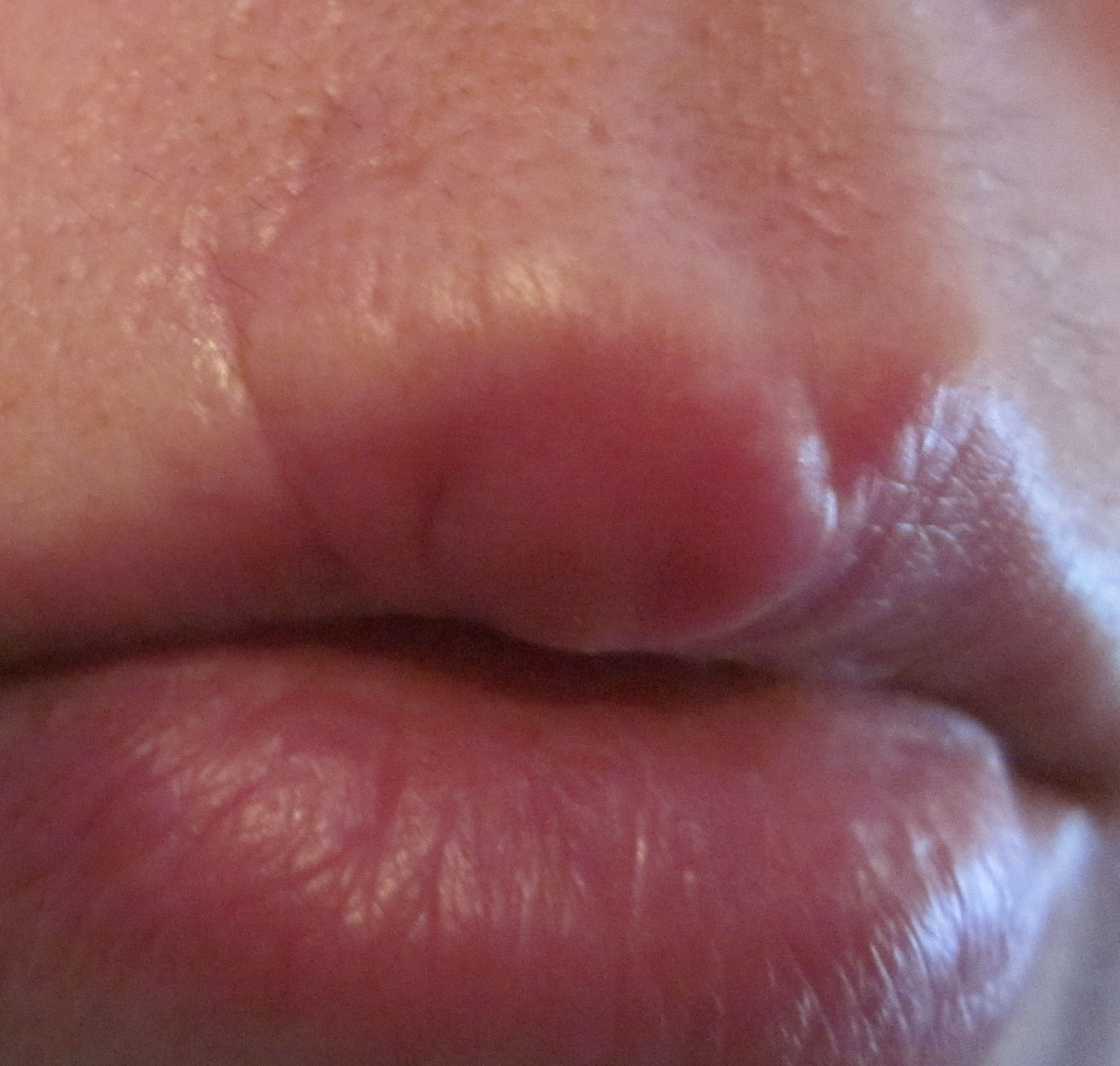 lumps on inside of lips